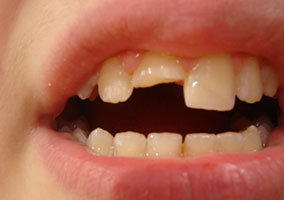 dente-rotto-bimbo