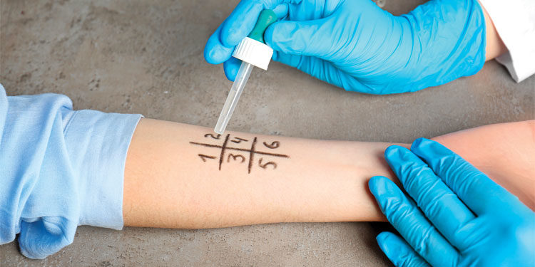 Skin Prick Test – come scoprire le allergie